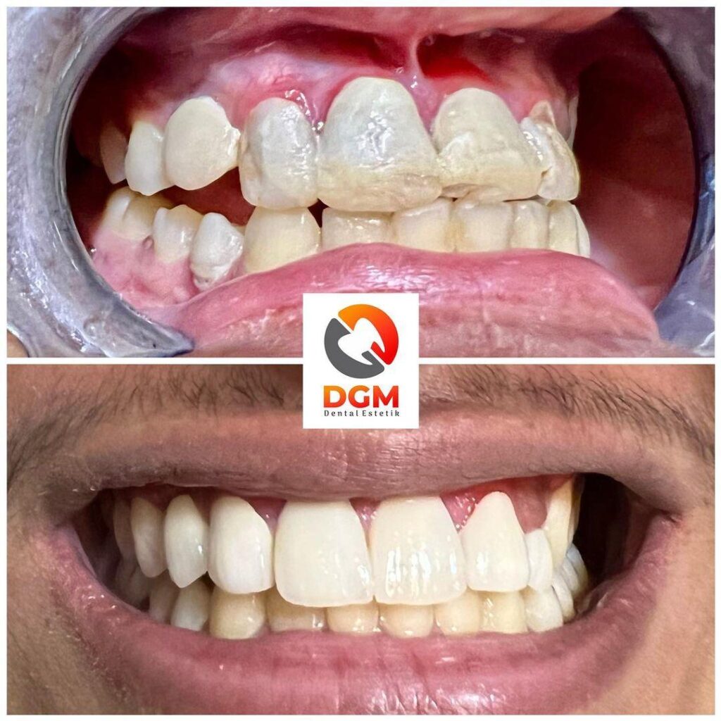 Crown Indirect Zirconia
