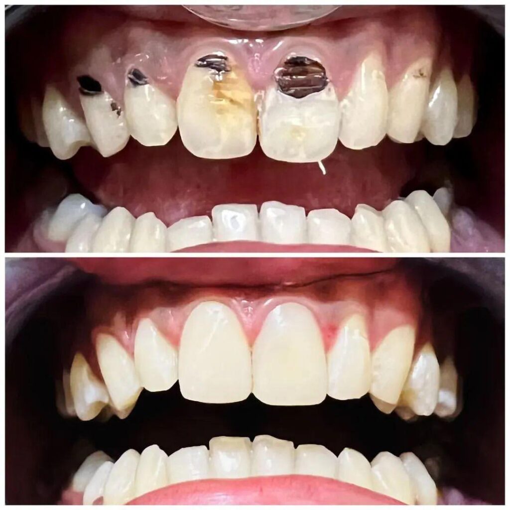 Veneer Direct